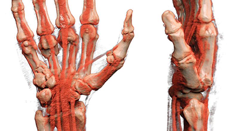 Fractured Metacarpals
